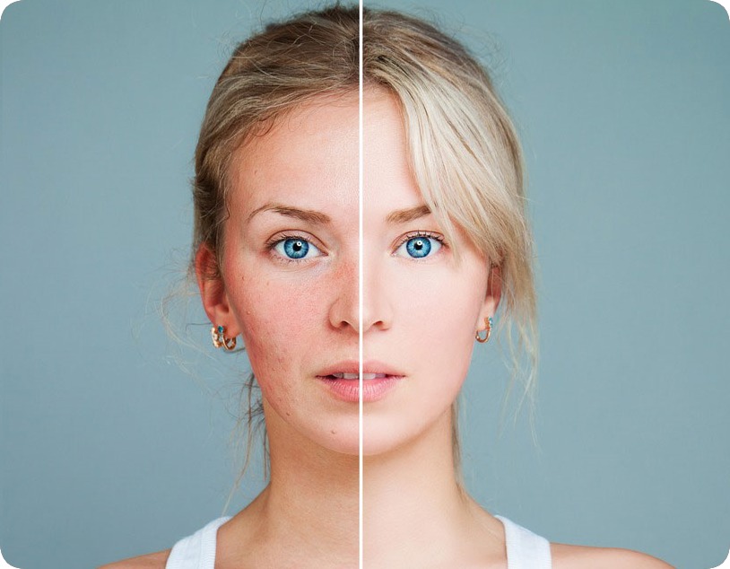 Bio-Microneedling